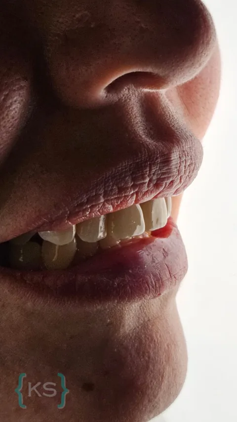 Caso real de un paciente con dientes amarillentos y manchados, antes del tratamiento.