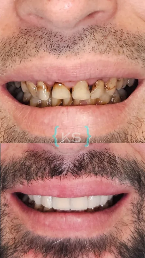 Antes y después de un tratamiento de estética dental: dientes manchados y desgastados, transformados en una sonrisa blanca y pareja.