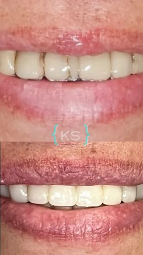 Antes y después de un tratamiento de estética dental: piezas oscurecidas y desparejas, transformadas en una sonrisa uniforme.