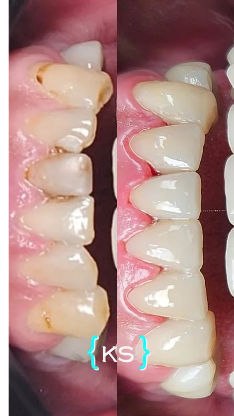 Antes y después de un tratamiento de estética dental, vista intraoral: piezas con desgaste y manchas, transformadas en una arcada pareja y luminosa.