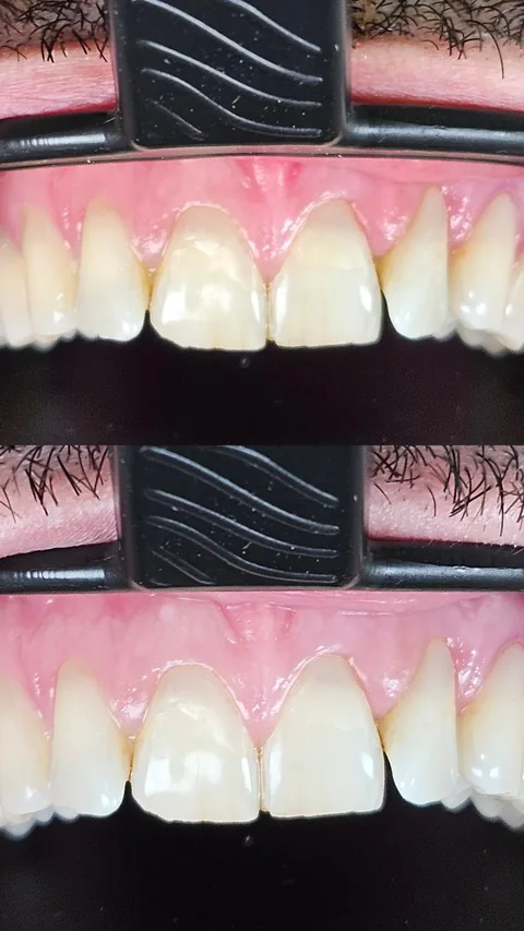 Antes y después de un blanqueamiento dental, vista intraoral: dientes amarillentos, transformados en una dentadura más clara y pareja.