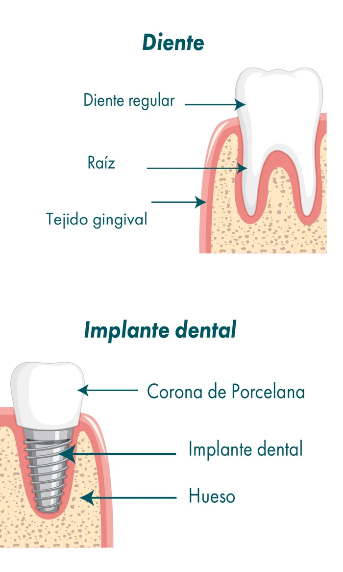 Corte comparativo entre un diente natural —con su raíz, tejido gingival y hueso— y un implante dental de titanio con corona de porcelana.