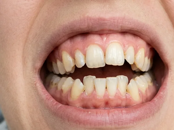 Sonrisa en la que los dientes de arriba y los de abajo no se encuentran al morder.