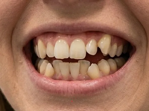 Sonrisa con varias piezas rotadas respecto del resto de la arcada.