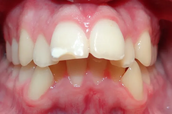 Antes del tratamiento: los dientes de arriba montados sobre los de abajo, apiñados y sin contacto entre las dos arcadas.