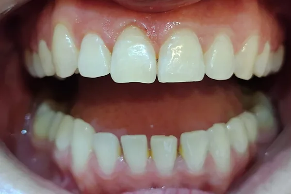 Después del tratamiento: los dientes de arriba alineados y parejos, con esa pieza ya en su posición correcta.