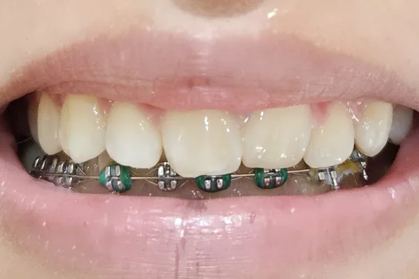 Antes del tratamiento: los dientes de arriba con brackets colocados, todavía en proceso de alineación.