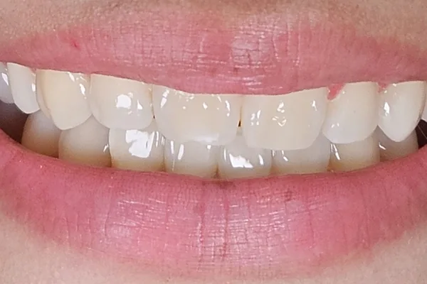 Después del tratamiento: la sonrisa con los dientes de arriba alineados y parejos.