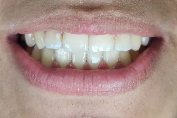 Después del tratamiento: los dientes de arriba alineados y parejos, en una sonrisa completa.
