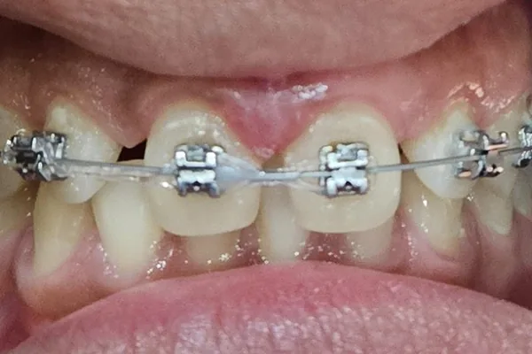 Antes del tratamiento: los dientes de arriba con brackets colocados y un espacio entre los incisivos centrales.