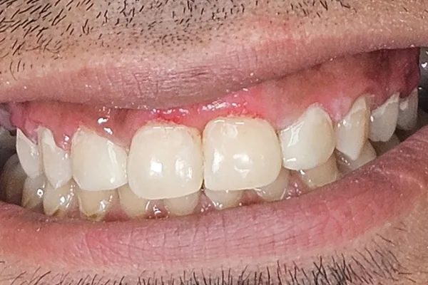 Después del tratamiento: los dientes de arriba alineados, sin el espacio entre los incisivos.